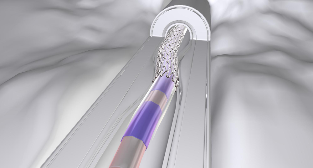 the-catheter-contains-a-specialized-tip-with-a-balloon-and-an-expandable-mesh-tube-called-a-stent-that-is-collapsed-around-the-balloon